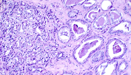 Hacia una nueva vía para combatir el cáncer de próstata resistente