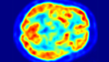 Una proteína asociada al Parkinson, podría estar relacionada con infecciones del tracto gastrointestinal superior humano