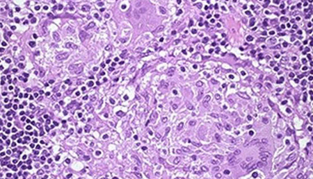 Descubren nuevos biomarcadores para identificar y combatir la Enfermedad de Crohn