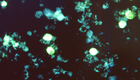 Una baja expresión de TRPM3 podría estar asociada al síndrome de fatiga crónica (SFC)