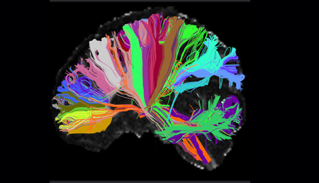 La esquizofrenia y la depresión podrían originarse a partir de un mismo substrato cerebral