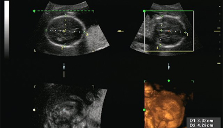 La esquizofrenia podría comenzar durante el desarrollo fetal