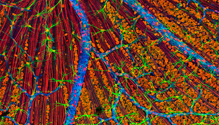 Un estudio analiza las bases moleculares de la comorbilidad entre Alzheimer y glioblastoma