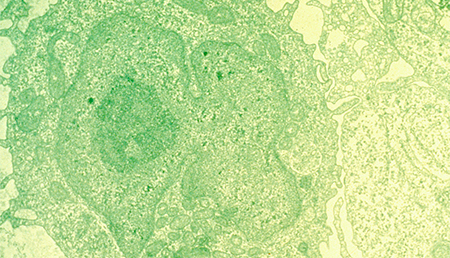 La exposición a la infección podría promover el desarrollo de la leucemia infantil de células B