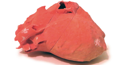 Señalan una nueva diana terapéutica que podría prevenir infartos en pacientes sanos