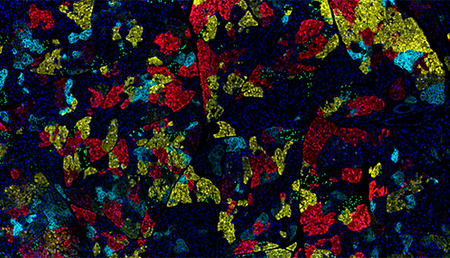 Investigadores descubren cómo una mutación genética promueve el hiperinsulinismo congénito