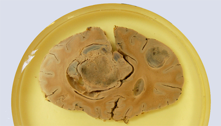 Viabilidad de RNA-Seq en muestras de glioblastoma