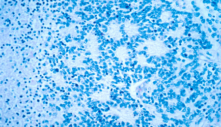 Una nueva diana molecular para mejorar el tratamiento del neuroblastoma