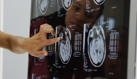 Detectar precozmente el glioma, cada vez más cerca con el desarrollo de un nuevo microdispositivo