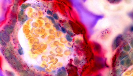 Asocian fallos de comunicación en las enzimas al cáncer, la dislipidemia y la osteoporosis