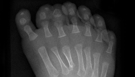 Identificado un nuevo gen mutado asociado a la polidactilia 