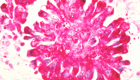 Identifican una conexión entre el receptor EphA2 y la caveolina 1 en el sarcoma de Ewing