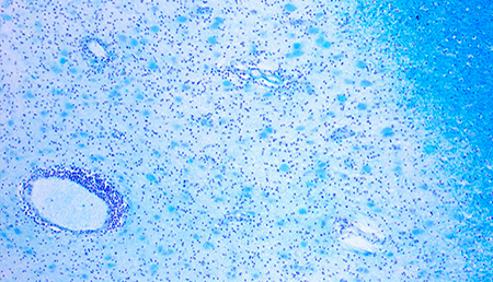 Descubren un nuevo posible biomarcador para la Esclerosis Múltiple