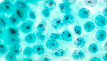 Algunos pacientes con enfermedad de Crohn carecen de una enzima epigenética