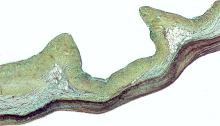 Los afectados por el síndrome de Marfan con alteraciones del gen Fribilin-1 podrían presentar una mayor proporción de eventos aórticos